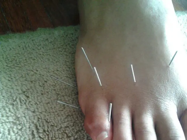 Unexplored Enigma: Small Fiber Nerve Injuries Stump Kaiser Permanente Researchers